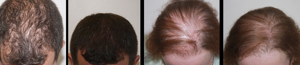 Laser Hair Therapy | Arizona Aesthetics Centers | laser therapy for hair loss