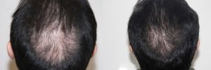 mens-hair-restoration-1