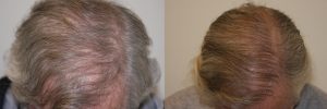 mens-hair-restoration-10