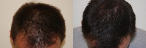 mens-hair-restoration-11