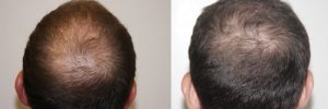 mens-hair-restoration-12