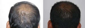 mens-hair-restoration-13