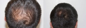 mens-hair-restoration-14