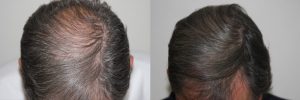 mens-hair-restoration-16