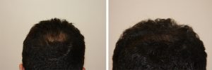 mens-hair-restoration-17