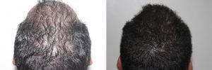 mens-hair-restoration-18