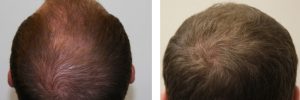 mens-hair-restoration-19