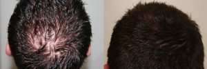 mens-hair-restoration-20