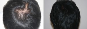 mens hair restoration - Arizona Aesthetics