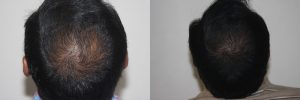 mens-hair-restoration-23