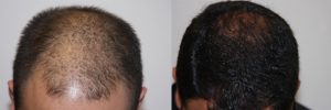 mens-hair-restoration-4