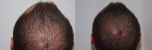 mens-hair-restoration-5