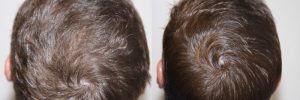 mens-hair-restoration-6
