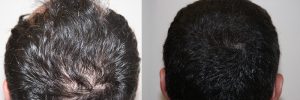 mens-hair-restoration-7