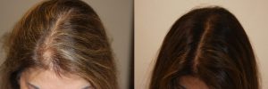 womens-hair-restoration-10