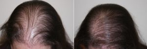 womens-hair-restoration-2