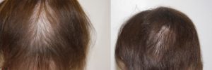 womens-hair-restoration-3