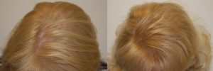 womens-hair-restoration-4