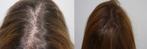womens-hair-restoration-5