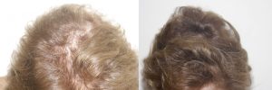 womens-hair-restoration-6