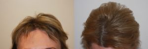 Stem Cell Therapy Treatment for Hair Loss