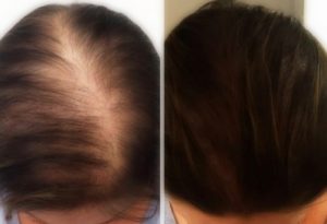 Scalp Micropigmentation Hair Loss